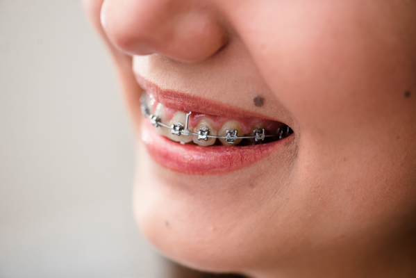 Receiving Traditional Braces From A General Dentist