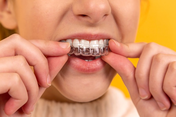 How Long Does It Take For Clear Braces To Straighten Your Teeth?